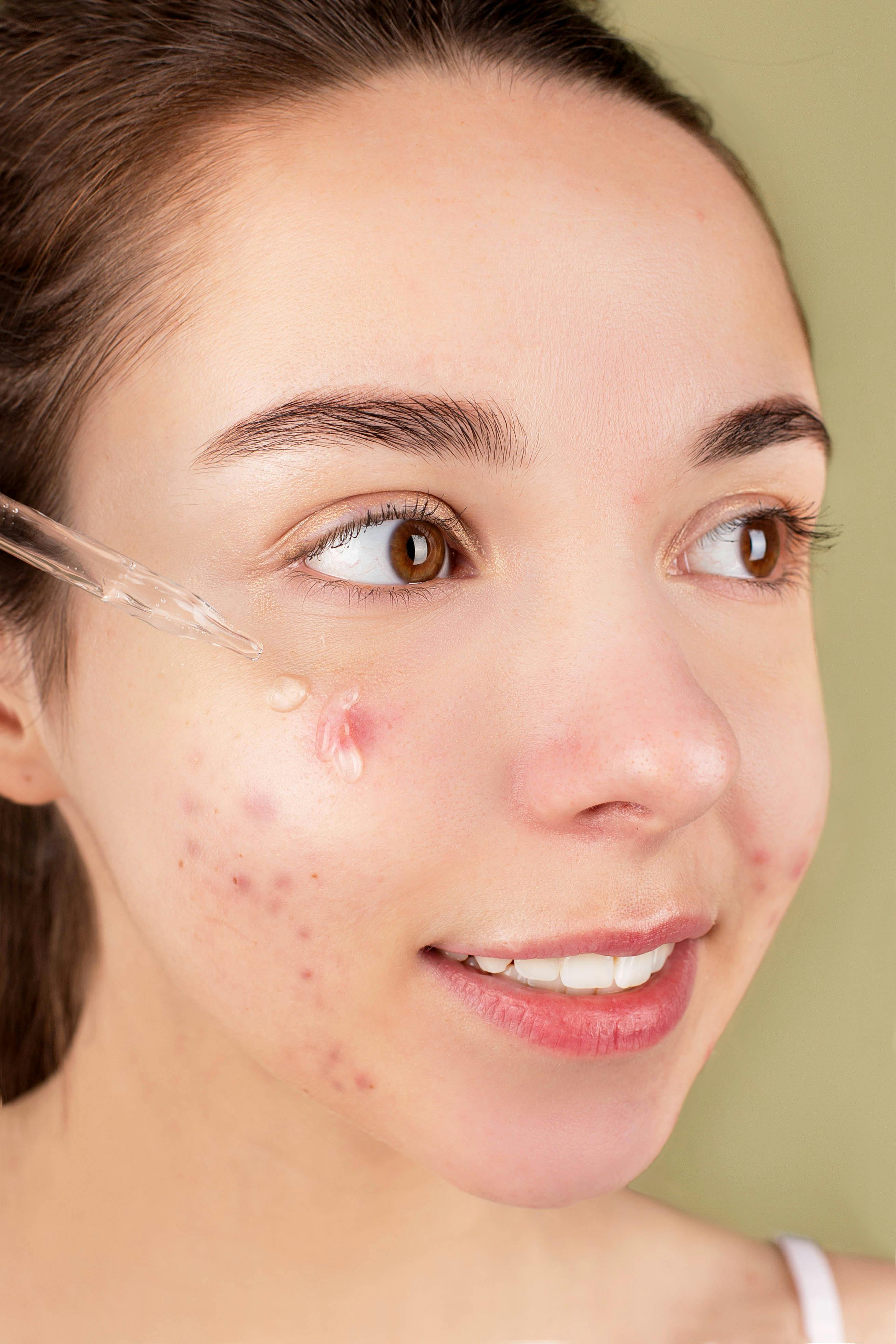 Best-at home Acne Scar Treatments: Coconut Oil, Hirudoid Gel, and The Ordinary